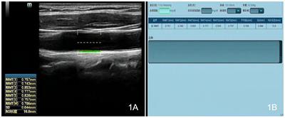 Evaluation of carotid artery elasticity and its influencing factors in non-obese PCOS patients using a technique for quantitative vascular elasticity measurement